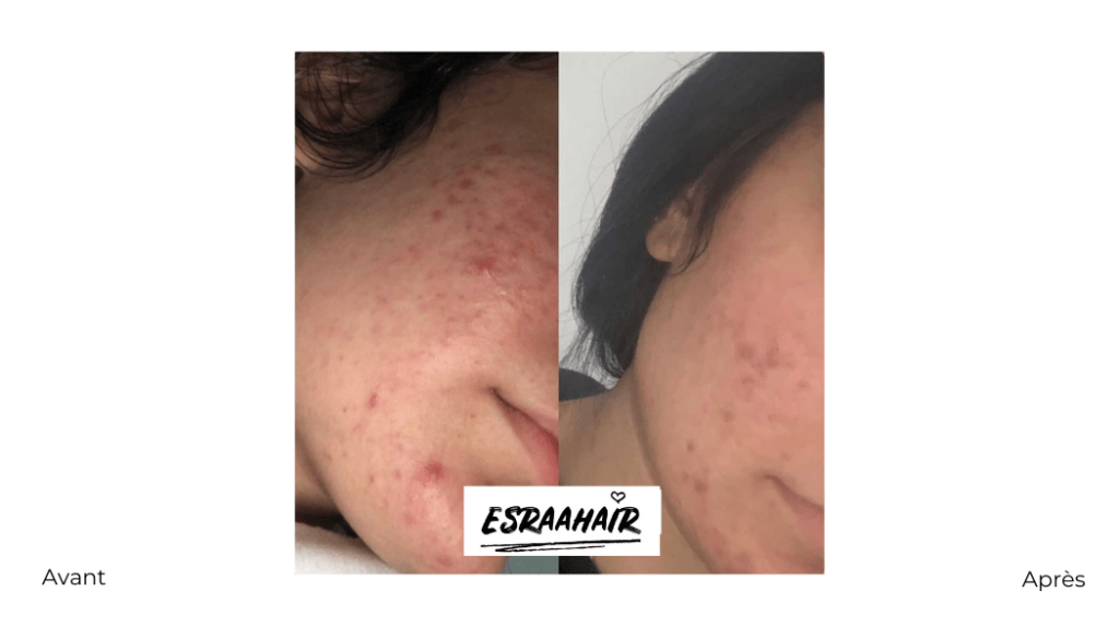 esrahair-avant-après-resultat-avis-coaching-skincare-peau-218