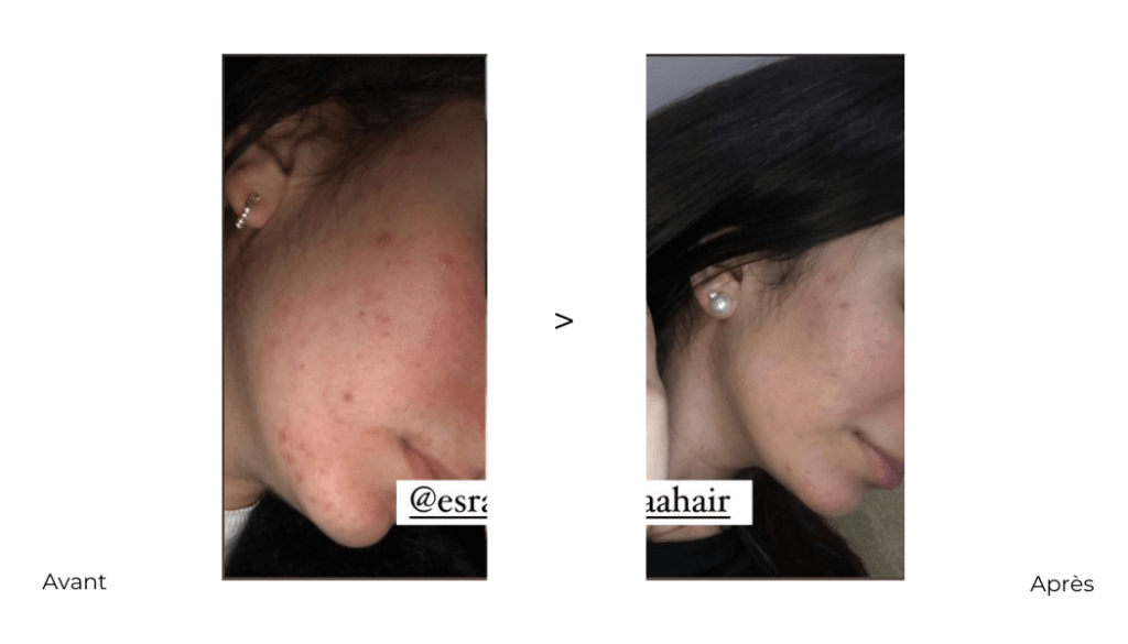 esrahair-avant-après-resultat-avis-coaching-skincare-peau15