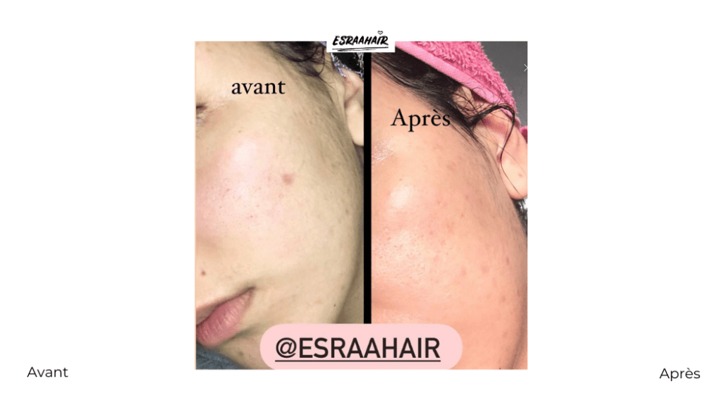 esrahair-avant-après-resultat-avis-coaching-skincare-peau16