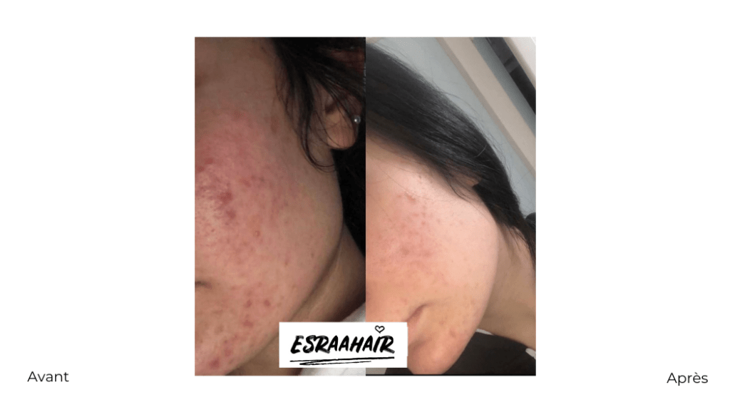 esrahair-avant-après-resultat-avis-coaching-skincare-peau17